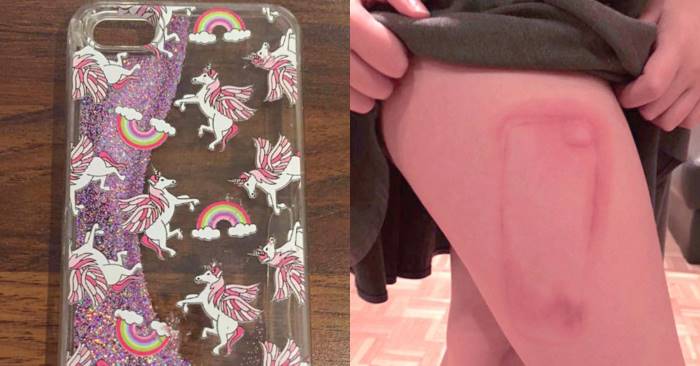 9-åringen sovnet med mobilen sin: Hun våknet med dette brennmerket på låret